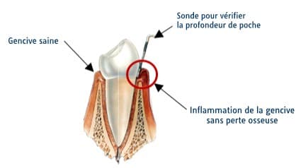 Schéma représentant une gencive inflammée..