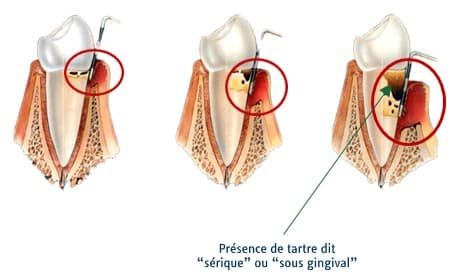 Schéma représentant une gencive inflammée..