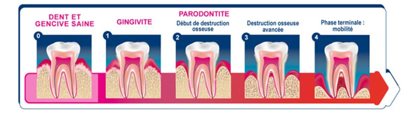 L'évolution des maladies parodontiques.